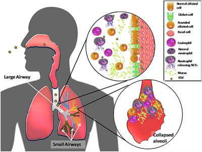 Host Components Contributing to Respiratory Syncytial Virus Pathogenesis